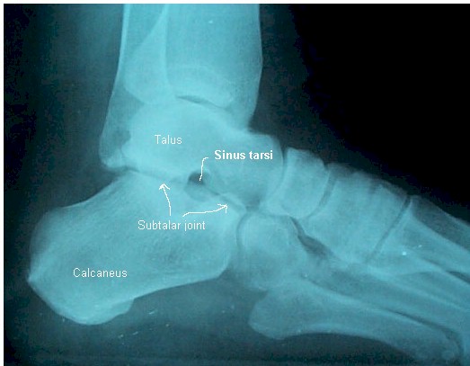 Sinus Tarsi Syndrome